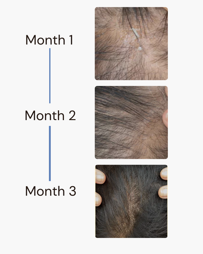 Finasteride 1mg (30 Tablets)